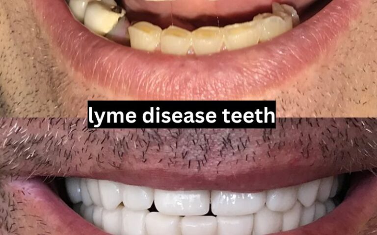 lyme disease teeth